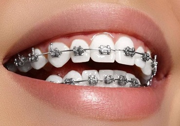 Teeth Braces Benefits