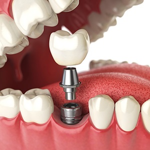 Immediate Loading dental implants bangalore 