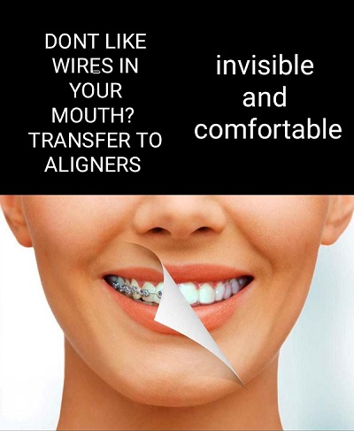 comfortable and invisible Braces