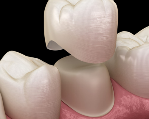 Dental Crowns