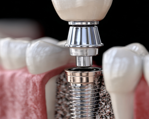immediate loading dental implants