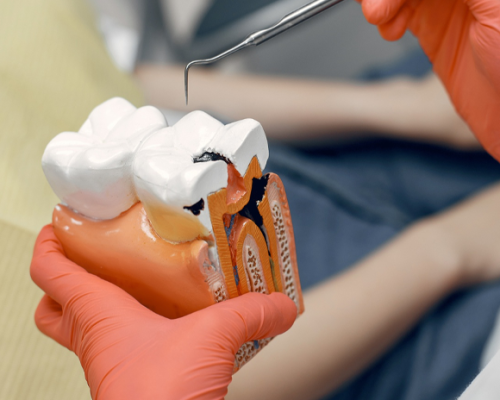 root canal treatment (1)